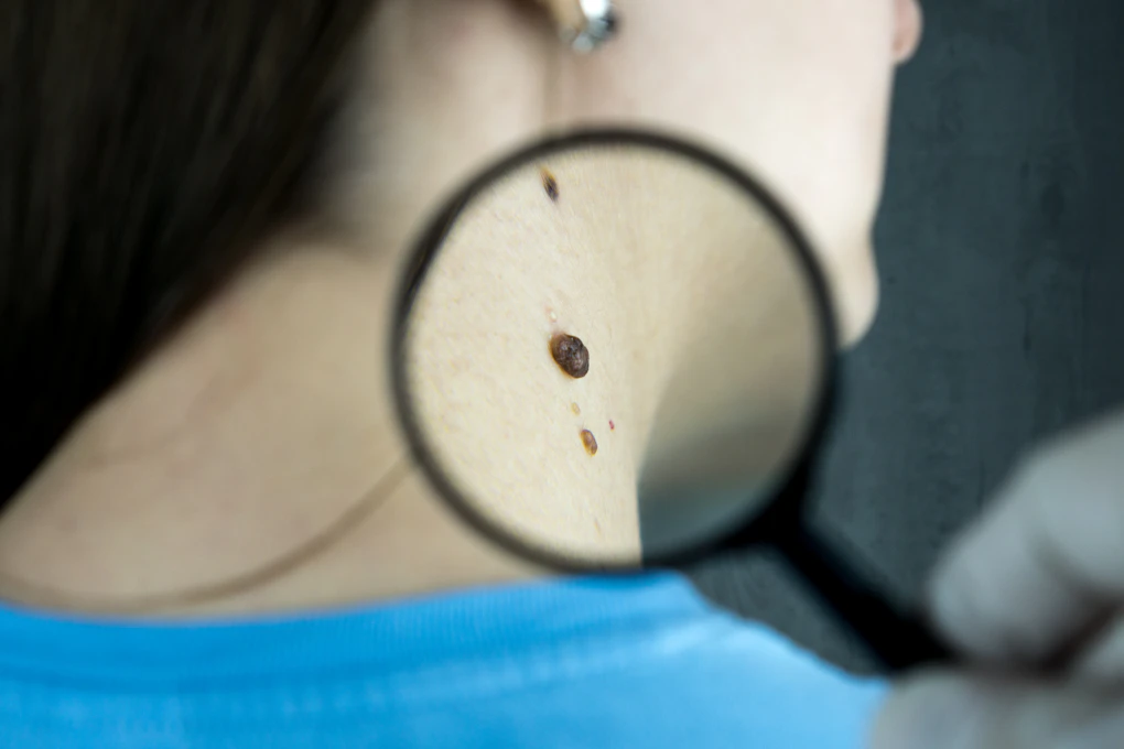Skin examined under a magnifying glass
